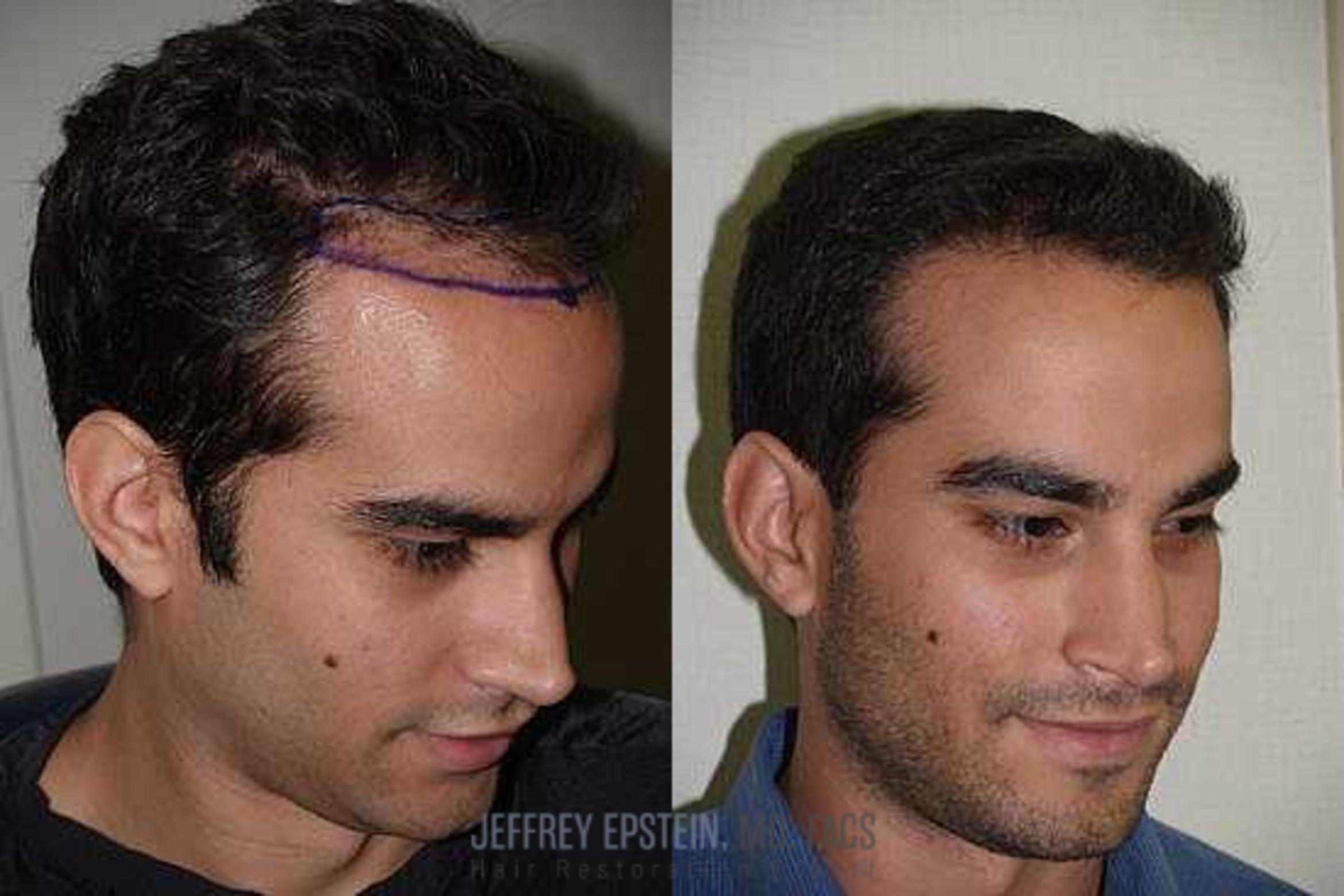 Before & After Hair Transplants For Men Case 132 View 3 View in Miami, FL