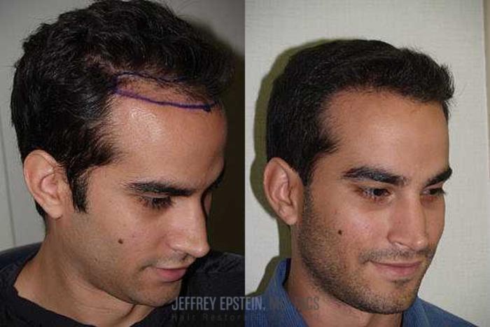 Before & After Hair Transplants For Men Case 132 View 3 View in Miami, FL