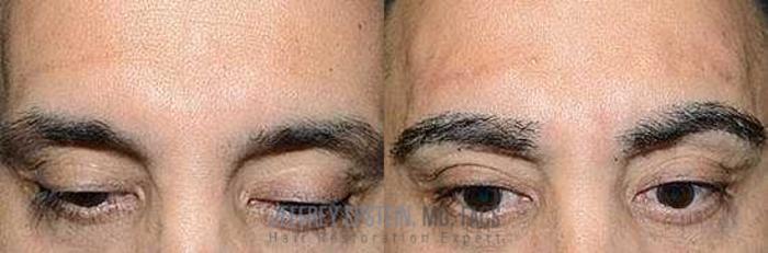 Before & After Hair Transplants For Men Case 133 View 1 View in Miami, FL
