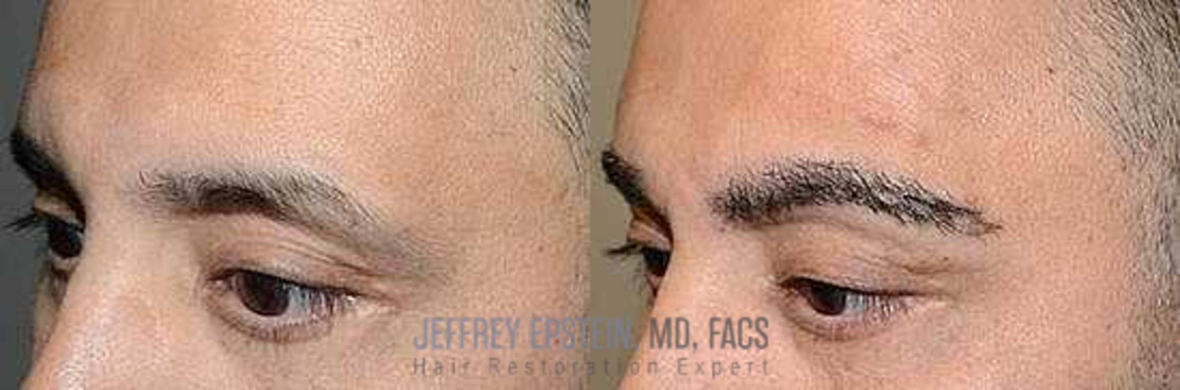 Before & After Hair Transplants For Men Case 133 View 2 View in Miami, FL