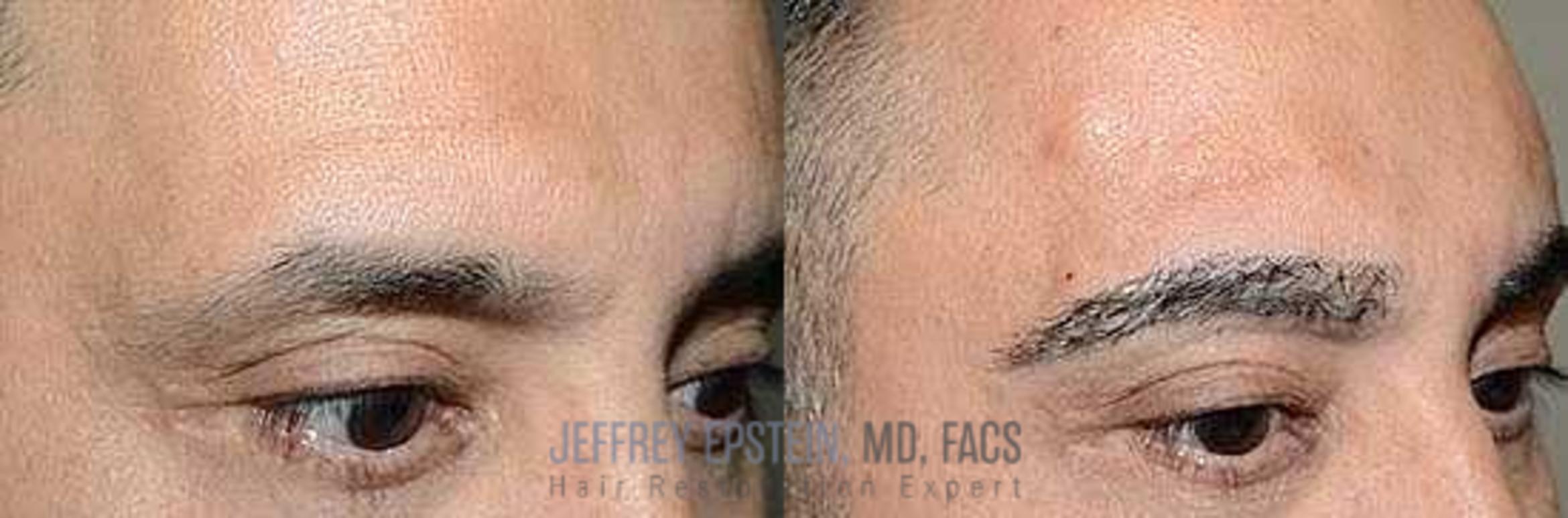 Before & After Hair Transplants For Men Case 133 View 3 View in Miami, FL