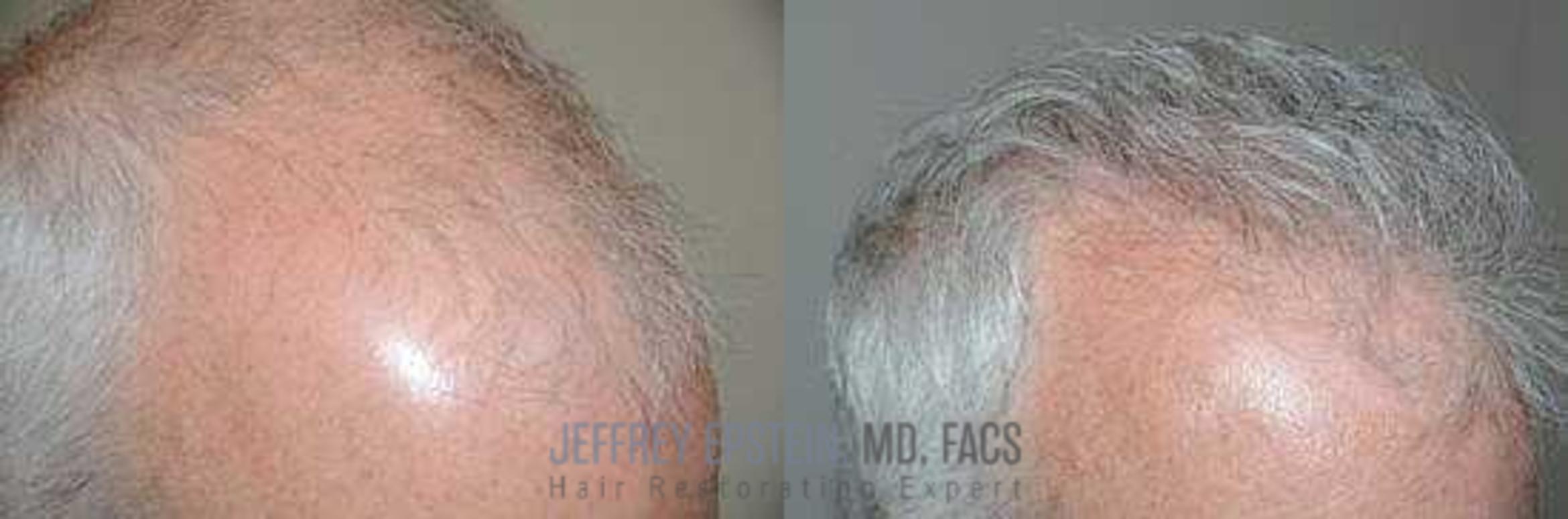 Before & After Hair Transplants For Men Case 134 View 2 View in Miami, FL