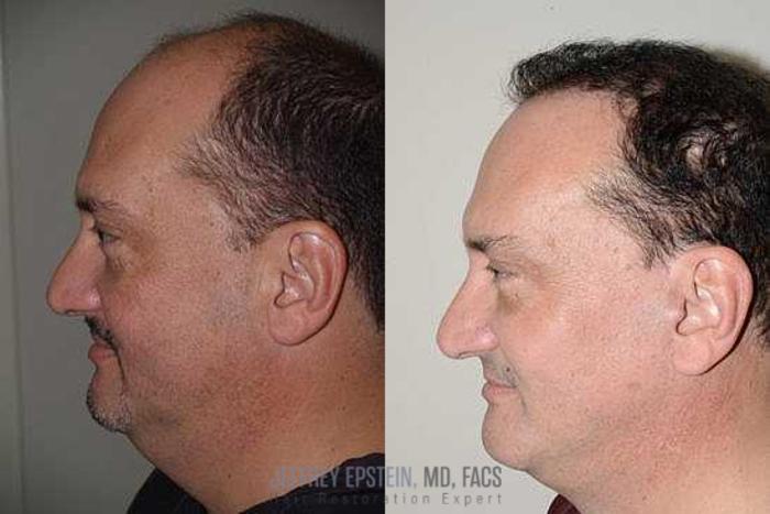 Before & After Hair Transplants For Men Case 135 View 1 View in Miami, FL