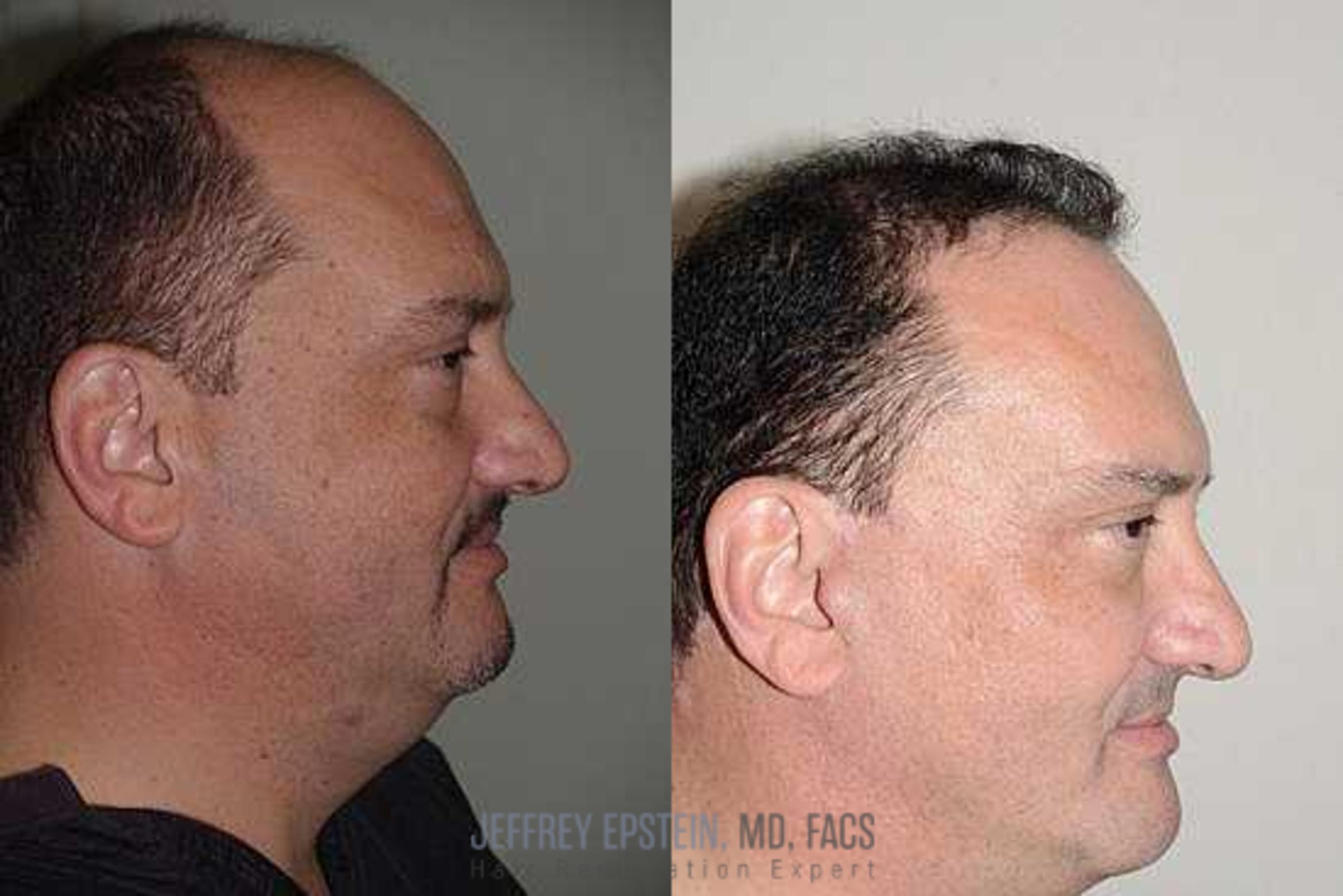 Before & After Hair Transplants For Men Case 135 View 2 View in Miami, FL