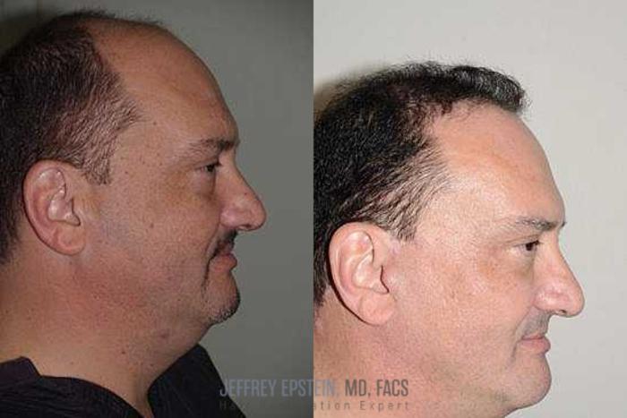 Before & After Hair Transplants For Men Case 135 View 2 View in Miami, FL