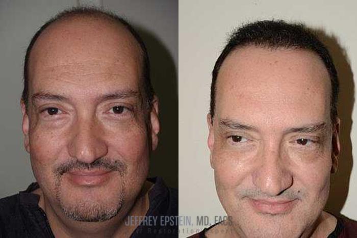 Before & After Hair Transplants For Men Case 135 View 3 View in Miami, FL