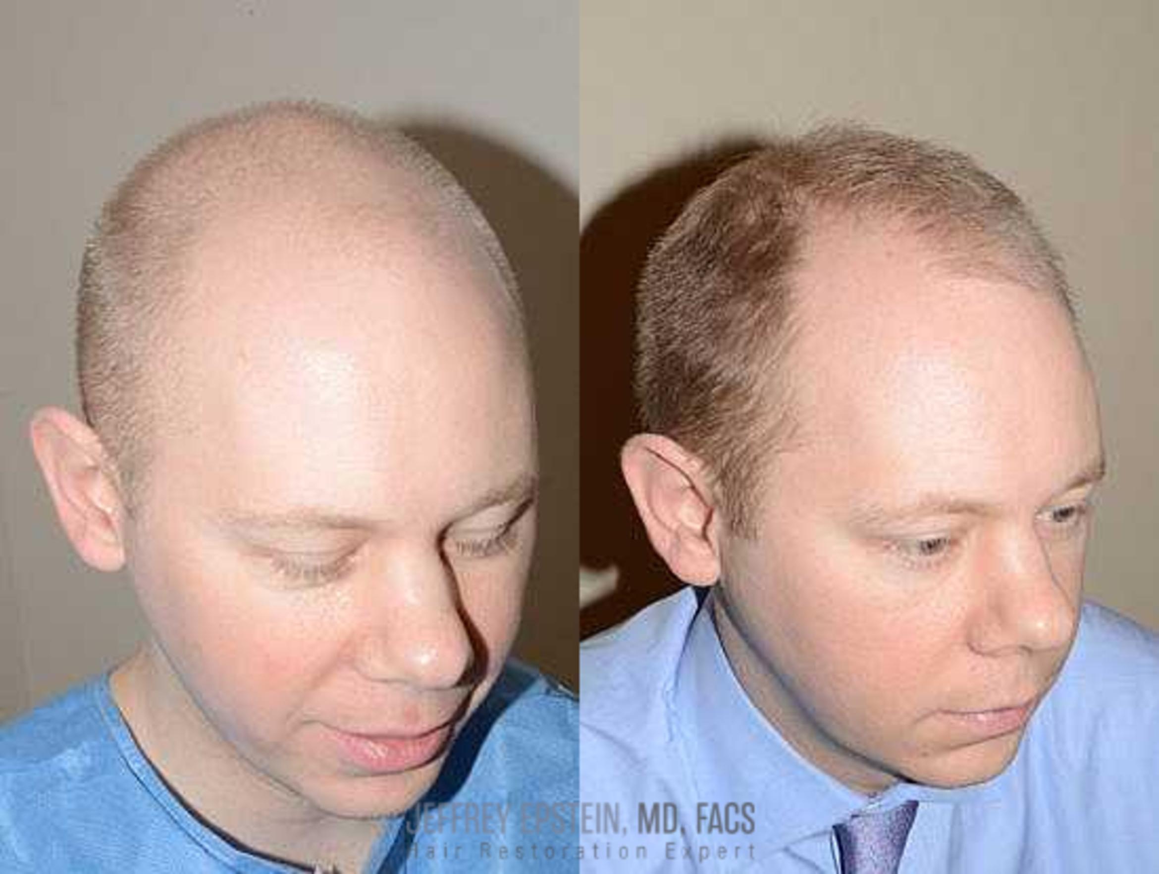 Before & After Hair Transplants For Men Case 136 View 1 View in Miami, FL