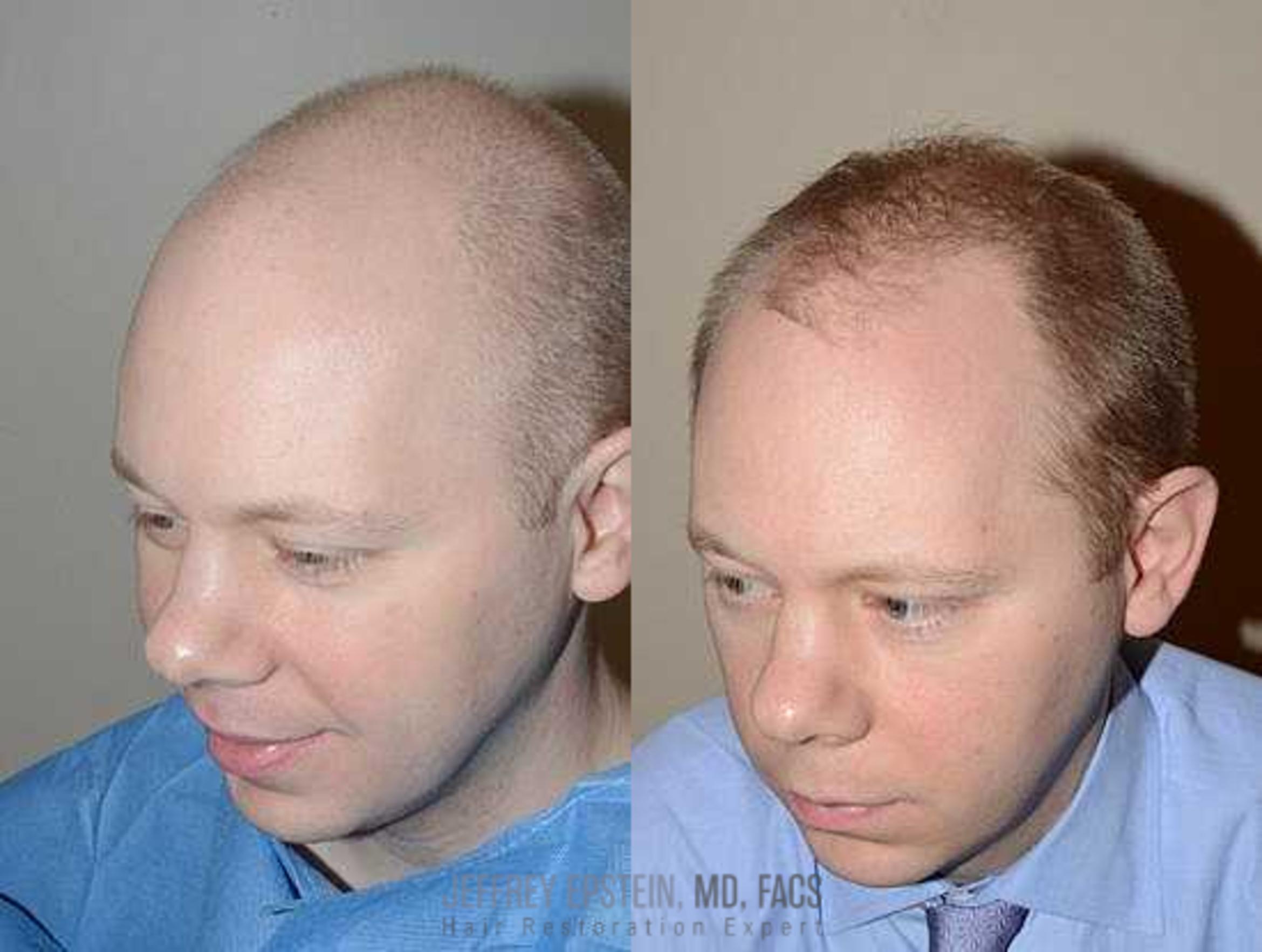Before & After Hair Transplants For Men Case 136 View 2 View in Miami, FL