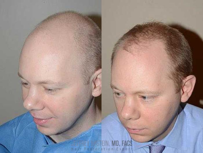 Before & After Hair Transplants For Men Case 136 View 2 View in Miami, FL