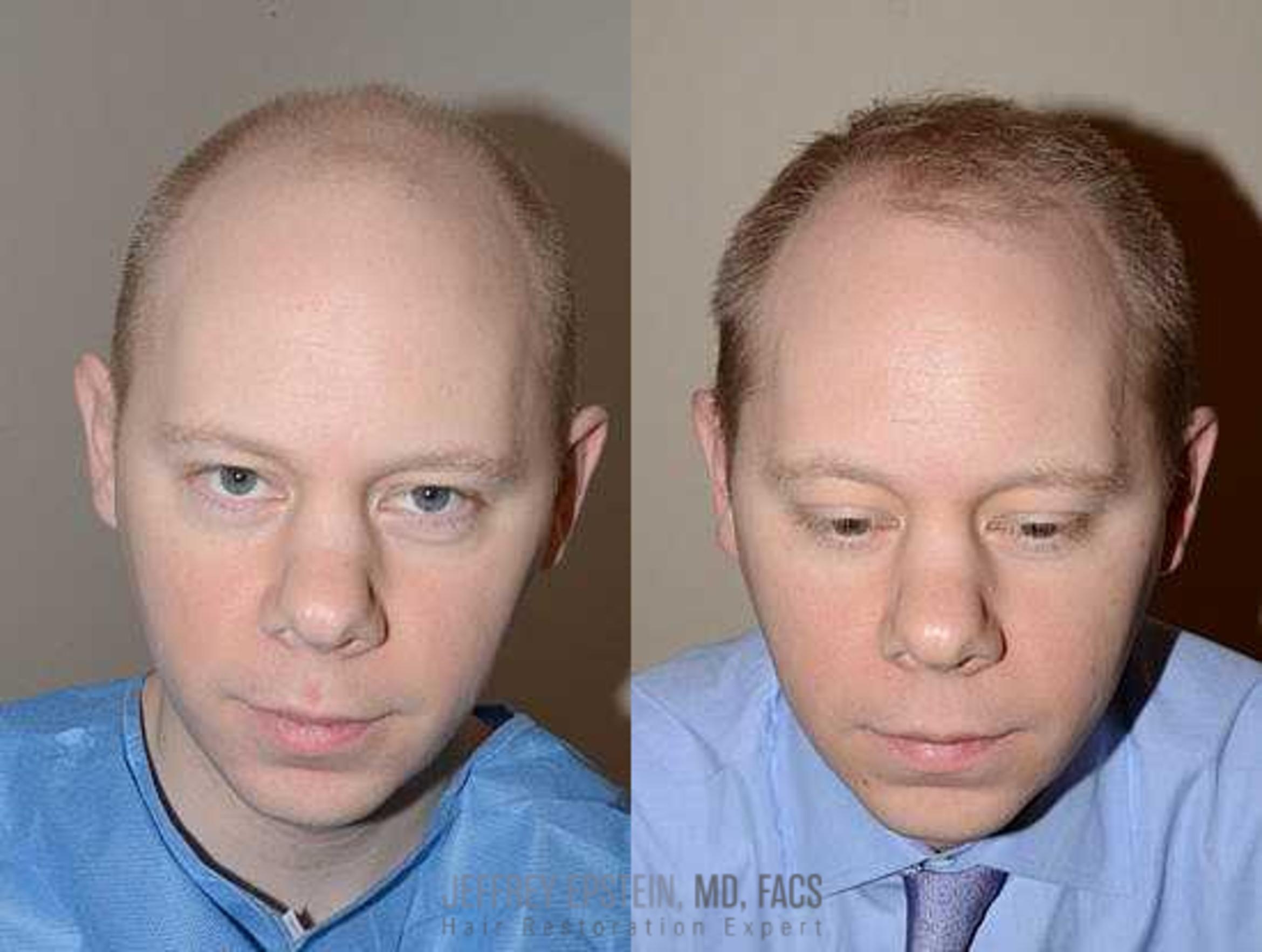 Before & After Hair Transplants For Men Case 136 View 3 View in Miami, FL