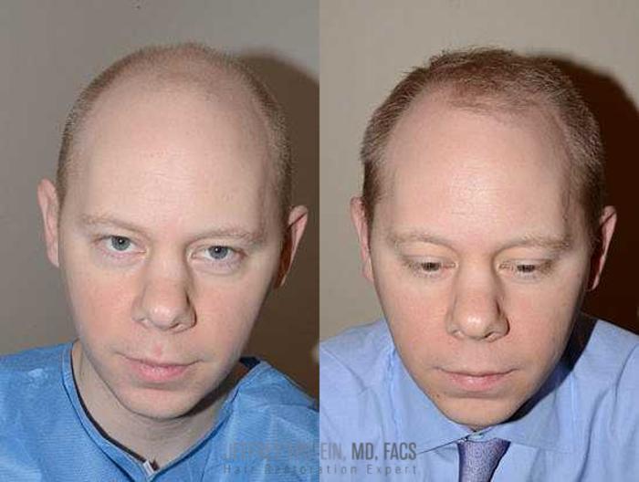 Before & After Hair Transplants For Men Case 136 View 3 View in Miami, FL