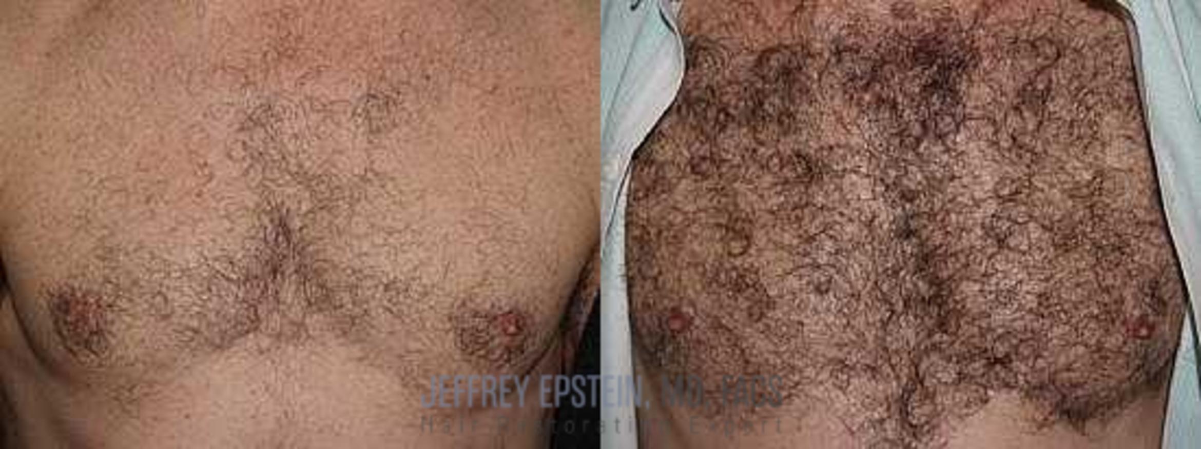Before & After Hair Transplants For Men Case 138 View 1 View in Miami, FL