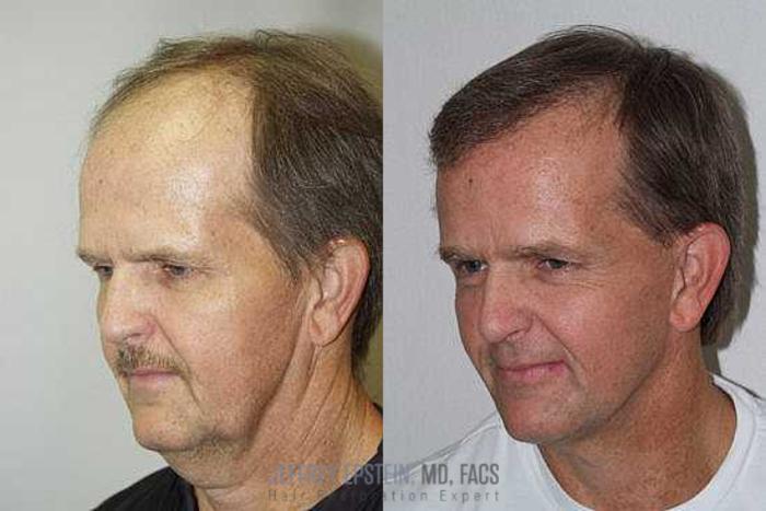 Before & After Hair Transplants For Men Case 139 View 1 View in Miami, FL