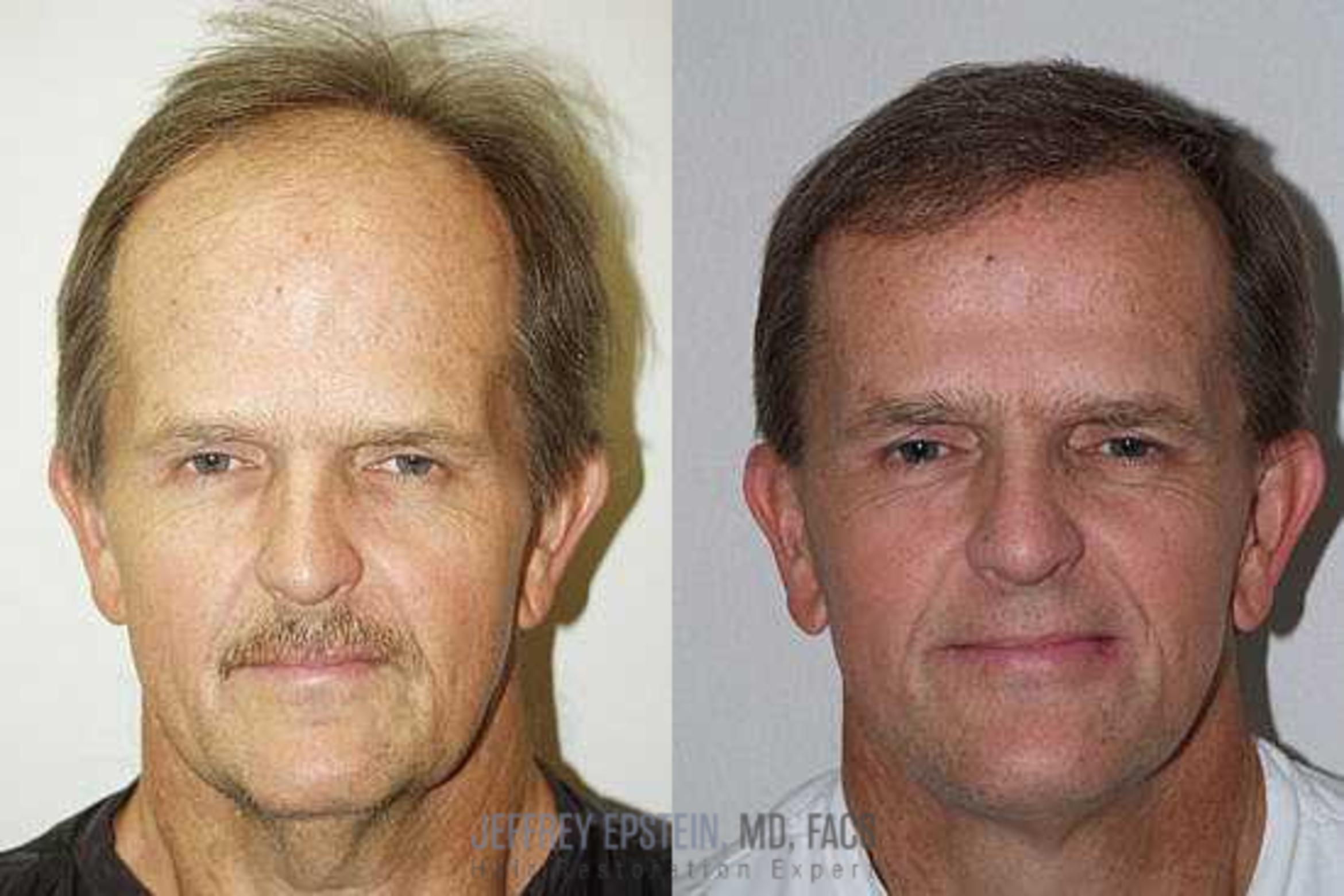 Before & After Hair Transplants For Men Case 139 View 2 View in Miami, FL