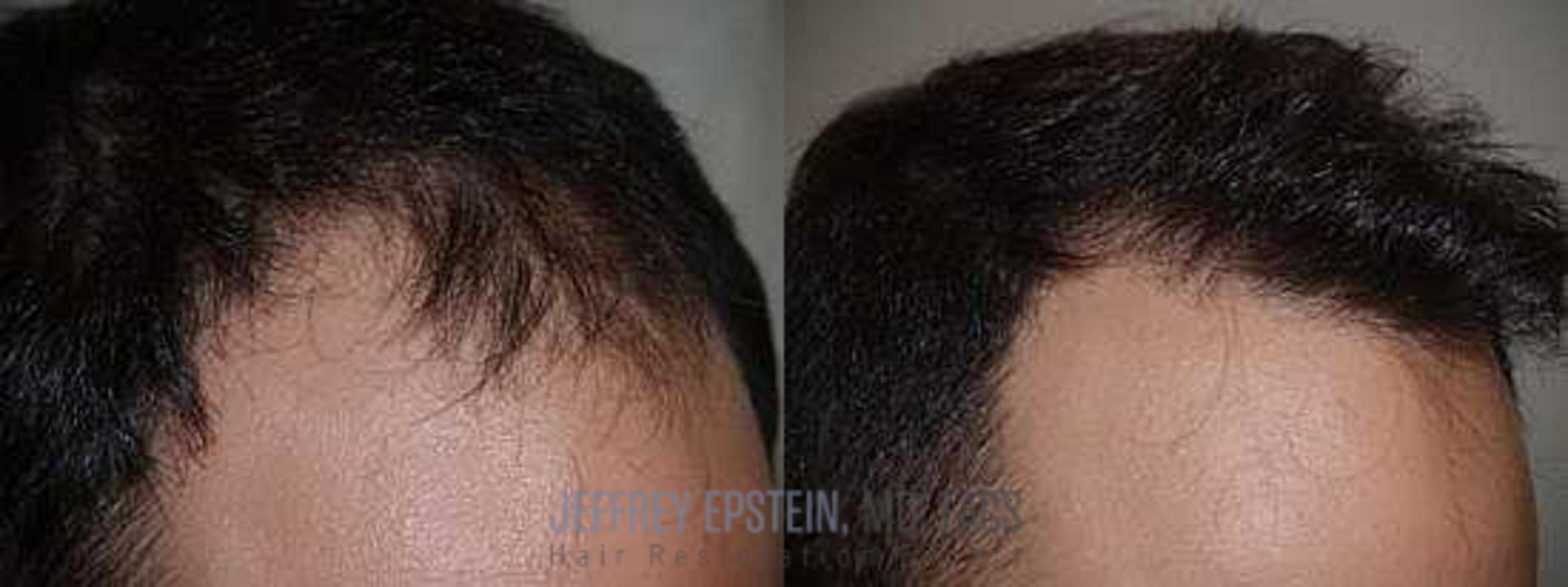 Before & After Hair Transplants For Men Case 140 View 1 View in Miami, FL