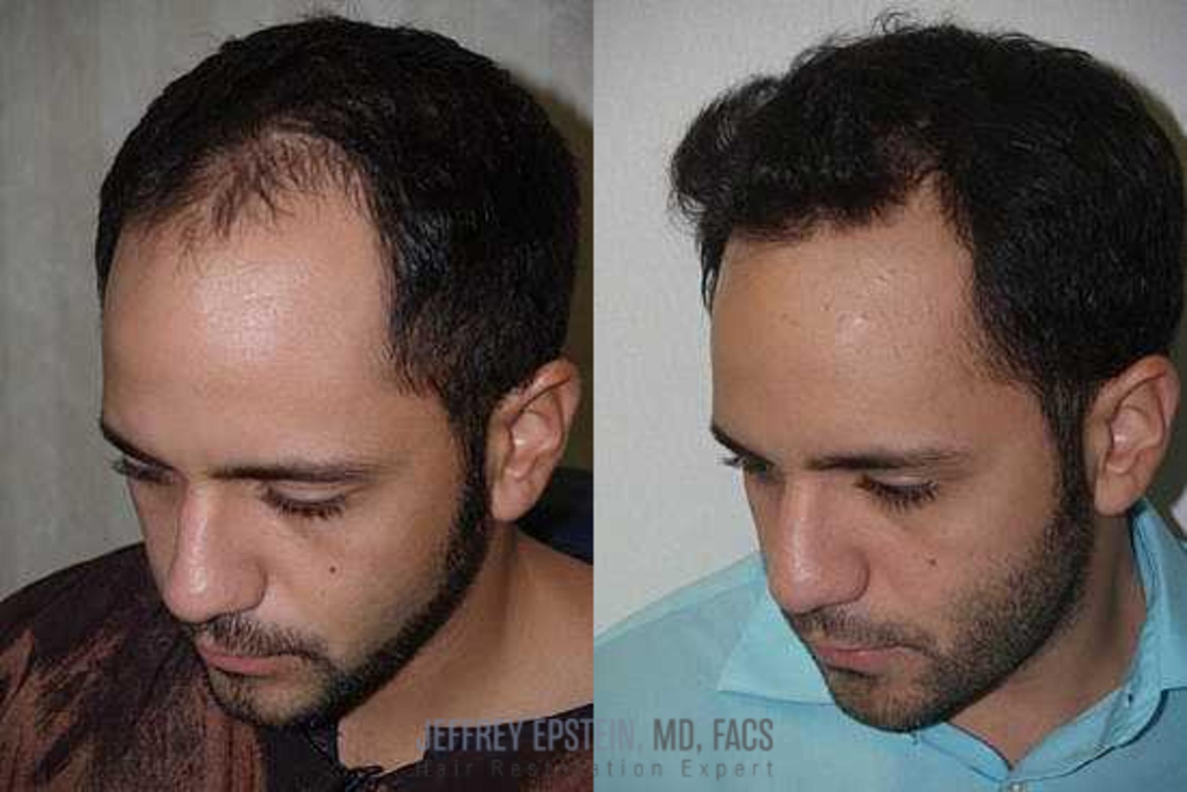 Before & After Hair Transplants For Men Case 140 View 2 View in Miami, FL