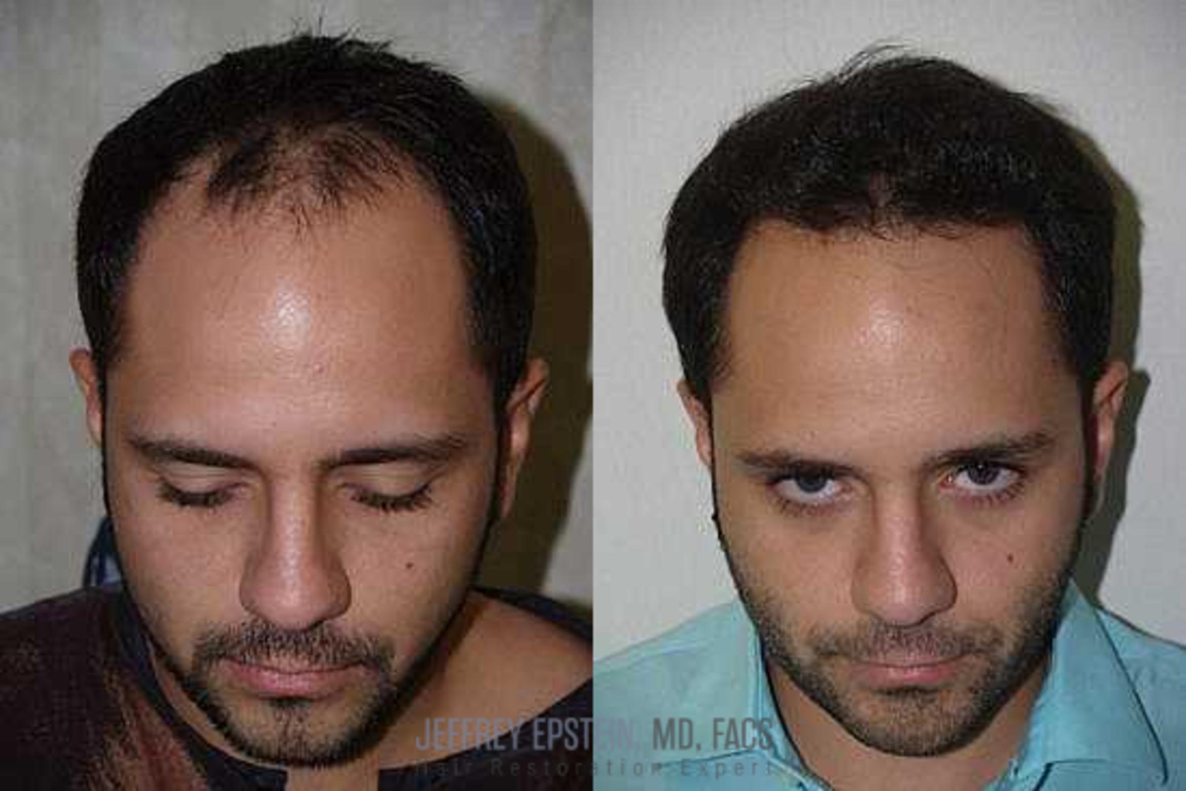 Before & After Hair Transplants For Men Case 140 View 3 View in Miami, FL