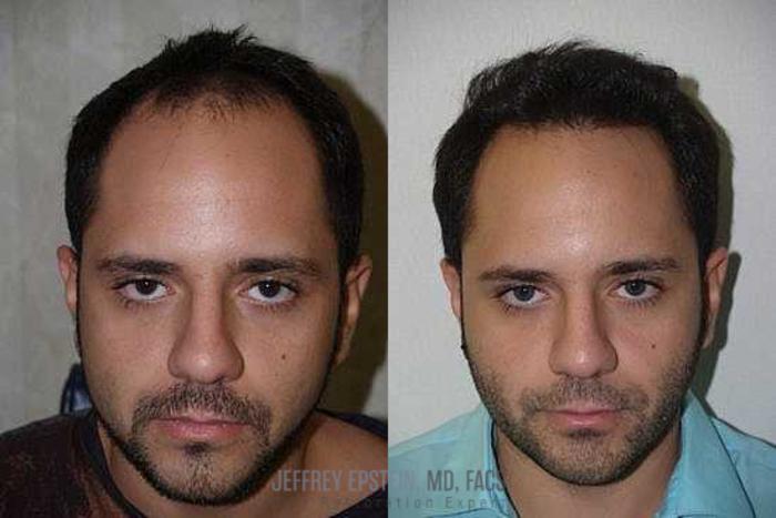 Before & After Hair Transplants For Men Case 140 View 4 View in Miami, FL