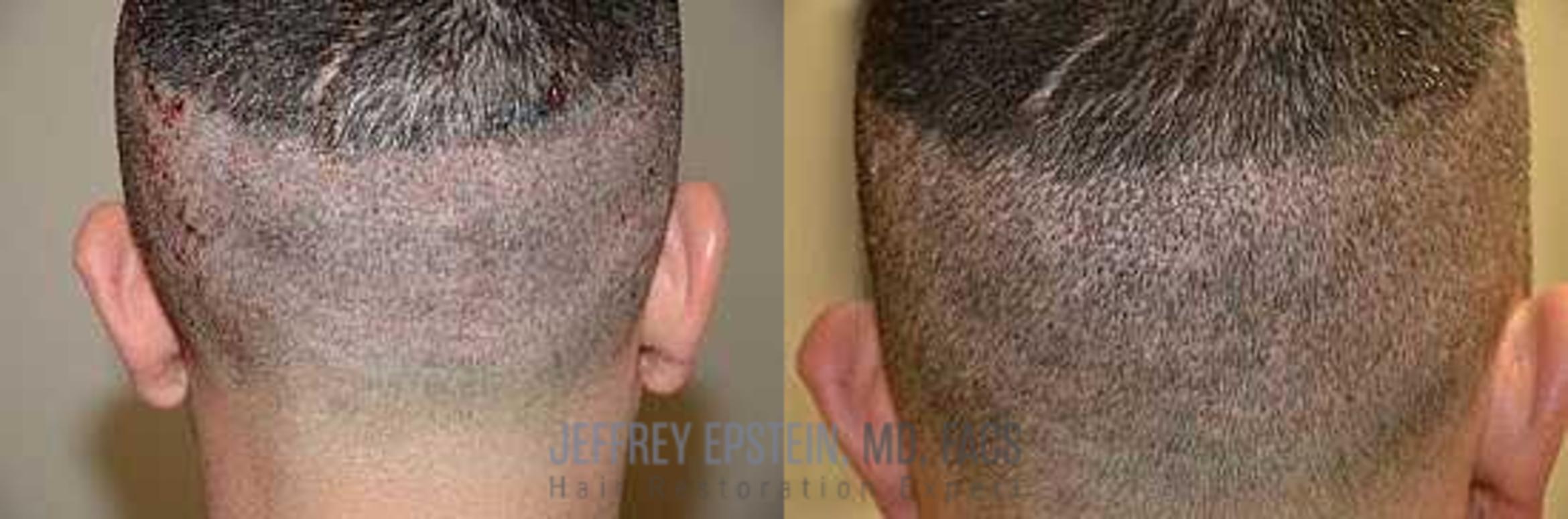 Before & After Hair Transplants For Men Case 141 View 1 View in Miami, FL