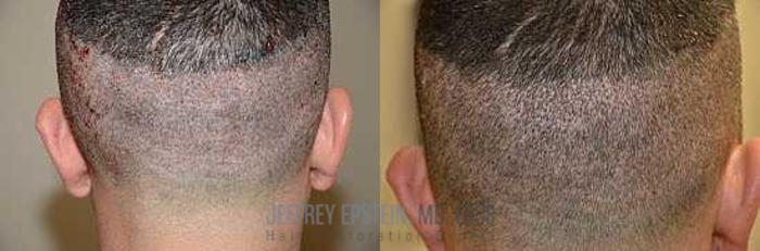 Before & After Hair Transplants For Men Case 141 View 1 View in Miami, FL