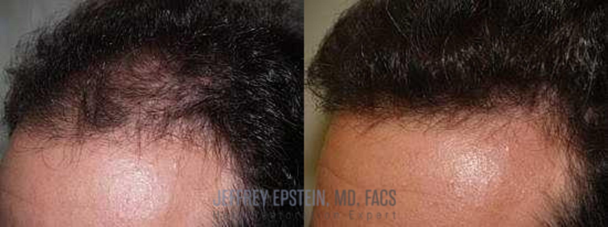 Before & After Hair Transplants For Men Case 142 View 1 View in Miami, FL