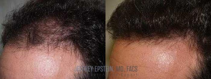 Before & After Hair Transplants For Men Case 142 View 1 View in Miami, FL