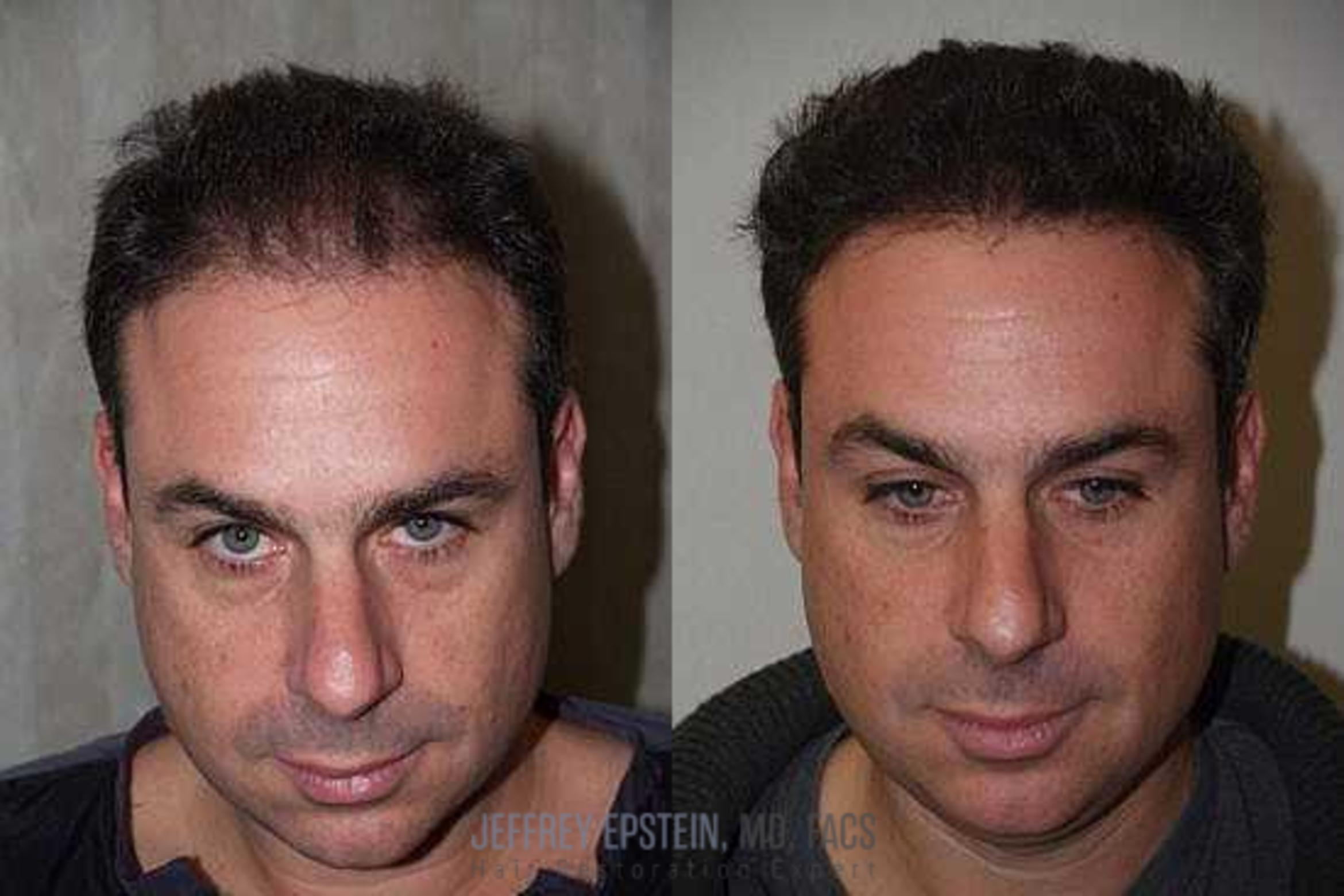 Before & After Hair Transplants For Men Case 142 View 2 View in Miami, FL