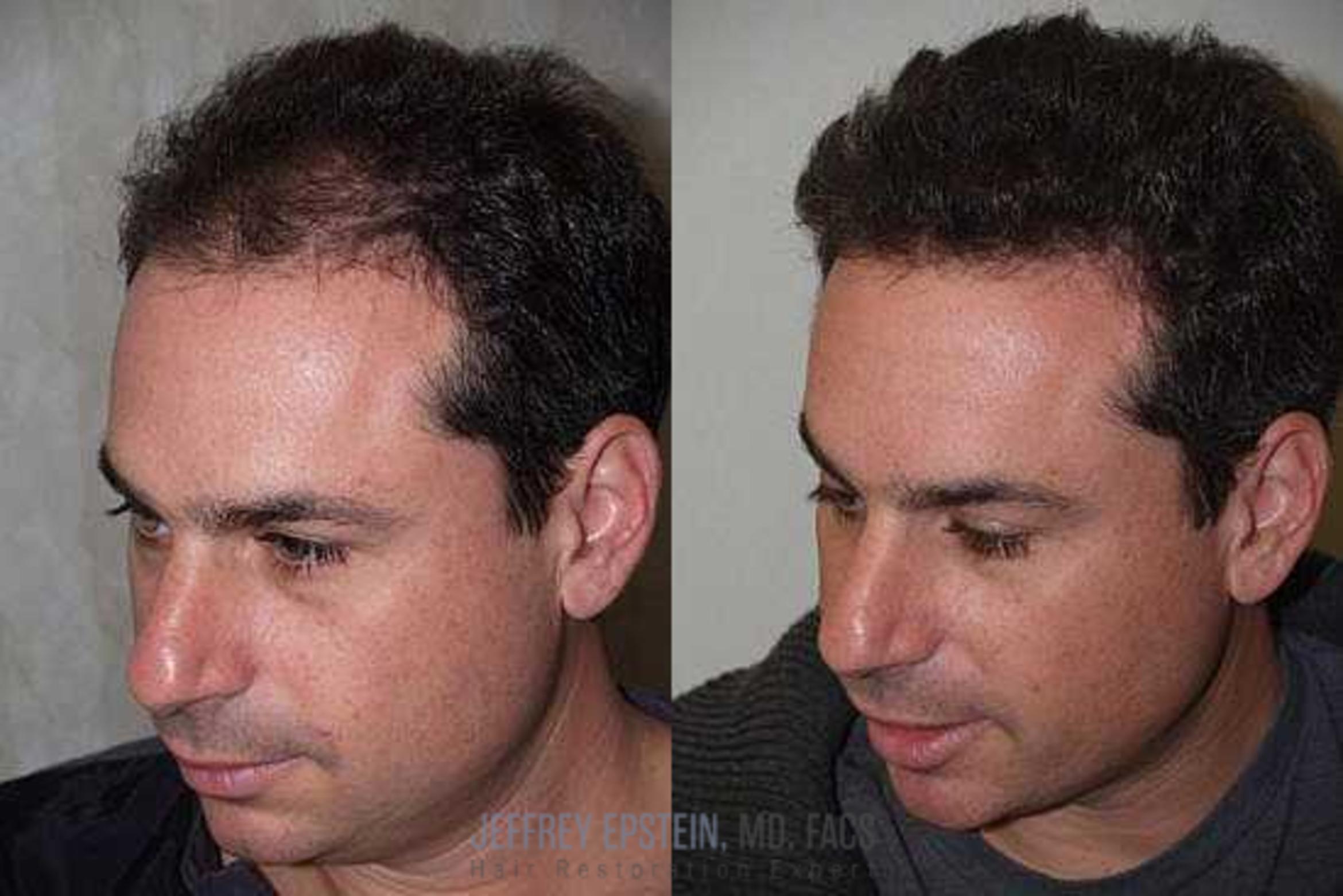 Before & After Hair Transplants For Men Case 142 View 3 View in Miami, FL
