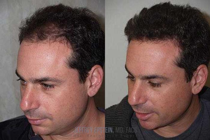 Before & After Hair Transplants For Men Case 142 View 3 View in Miami, FL