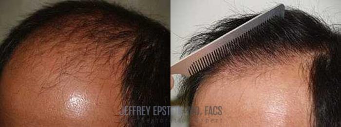 Before & After Hair Transplants For Men Case 144 View 1 View in Miami, FL