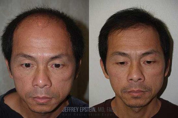 Before & After Hair Transplants For Men Case 144 View 2 View in Miami, FL