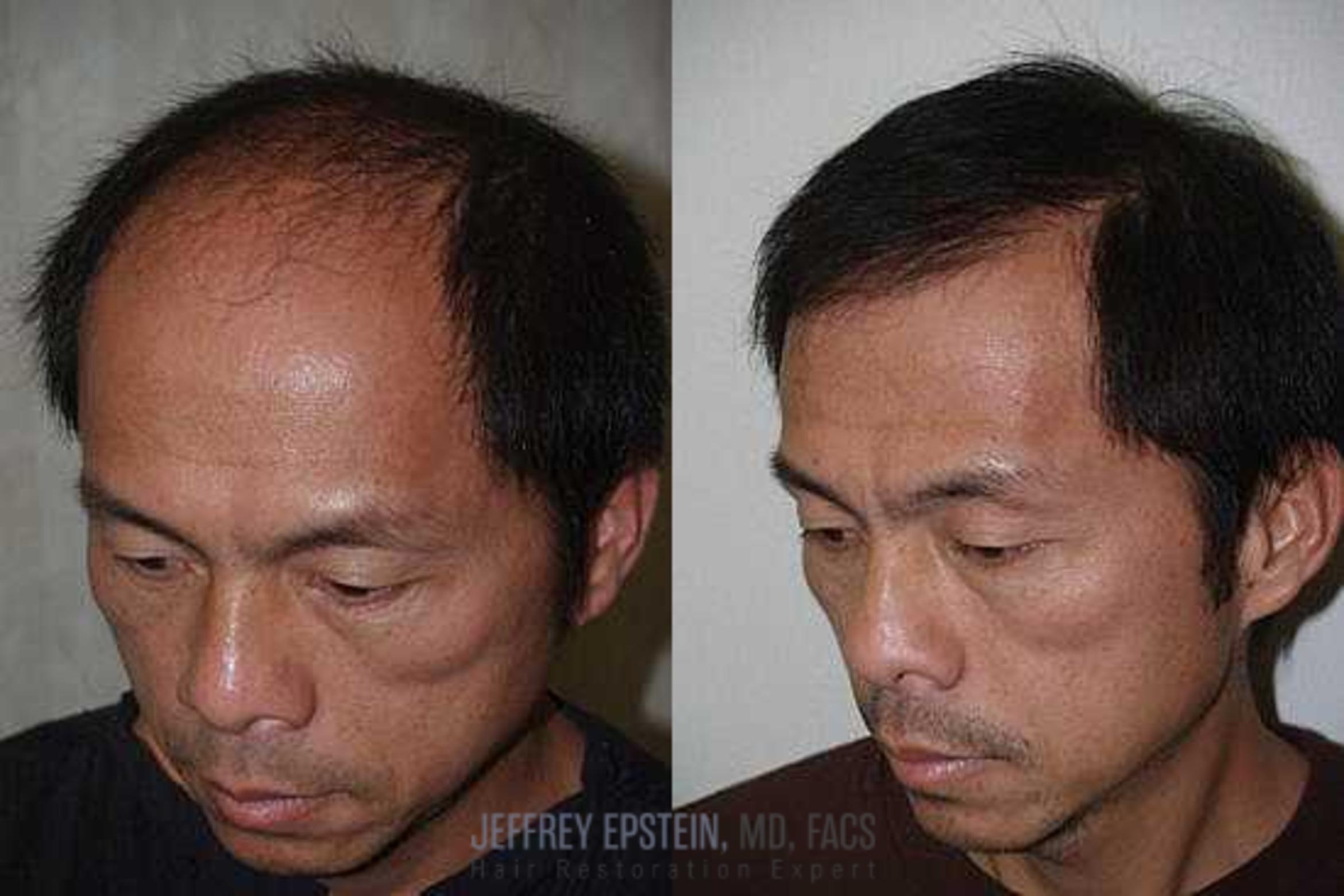 Before & After Hair Transplants For Men Case 144 View 3 View in Miami, FL