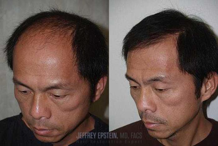 Before & After Hair Transplants For Men Case 144 View 3 View in Miami, FL