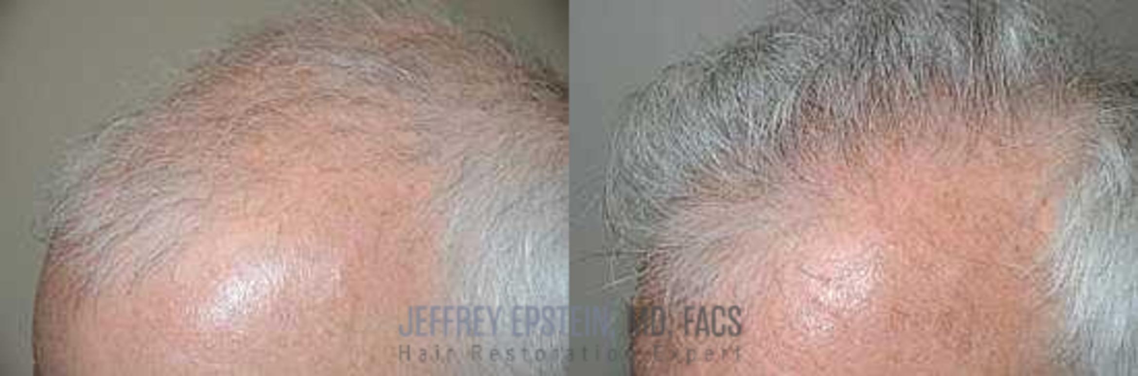 Before & After Hair Transplants For Men Case 145 View 1 View in Miami, FL