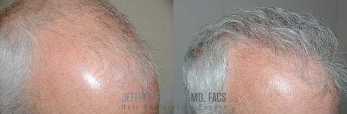 Before & After Hair Transplants For Men Case 145 View 2 View in Miami, FL