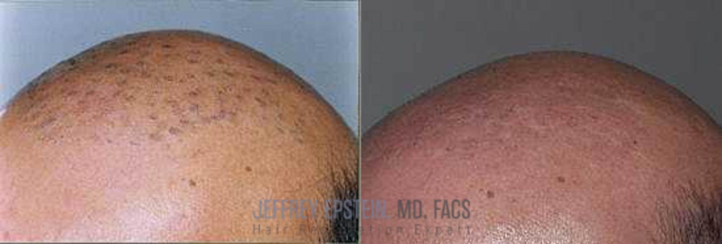 Before & After Hair Transplants For Men Case 146 View 1 View in Miami, FL