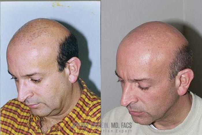 Before & After Hair Transplants For Men Case 146 View 2 View in Miami, FL