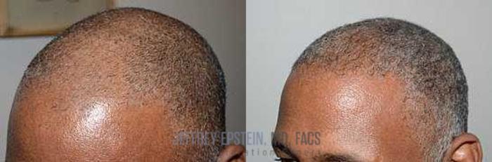 Before & After Hair Transplants For Men Case 149 View 1 View in Miami, FL