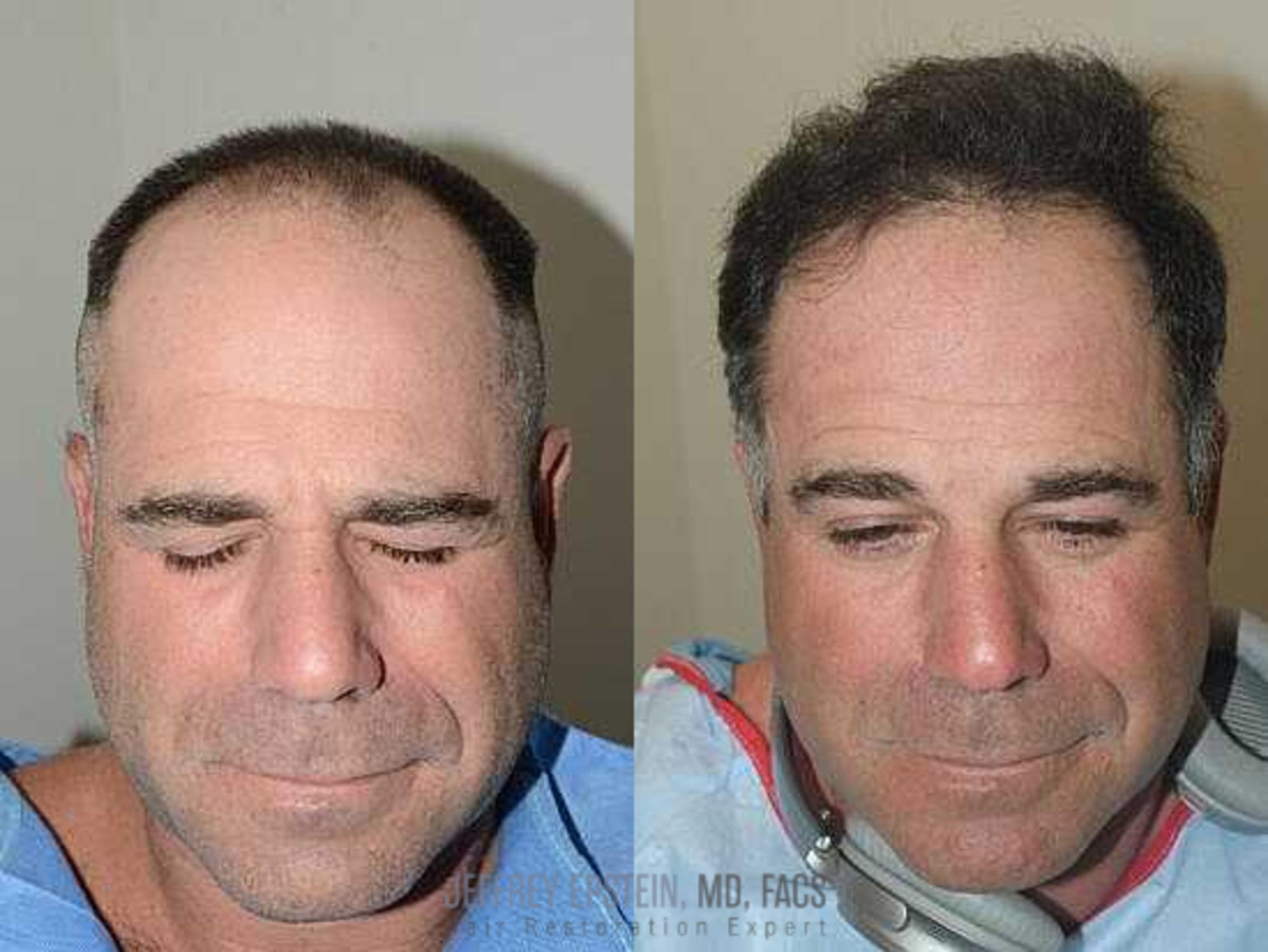 Before & After Hair Transplants For Men Case 15 View 1 View in Miami, FL