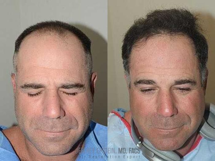 Before & After Hair Transplants For Men Case 15 View 1 View in Miami, FL