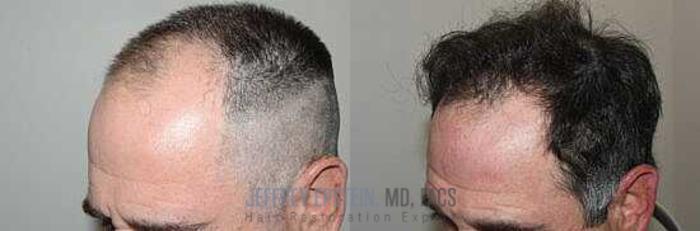 Before & After Hair Transplants For Men Case 15 View 2 View in Miami, FL