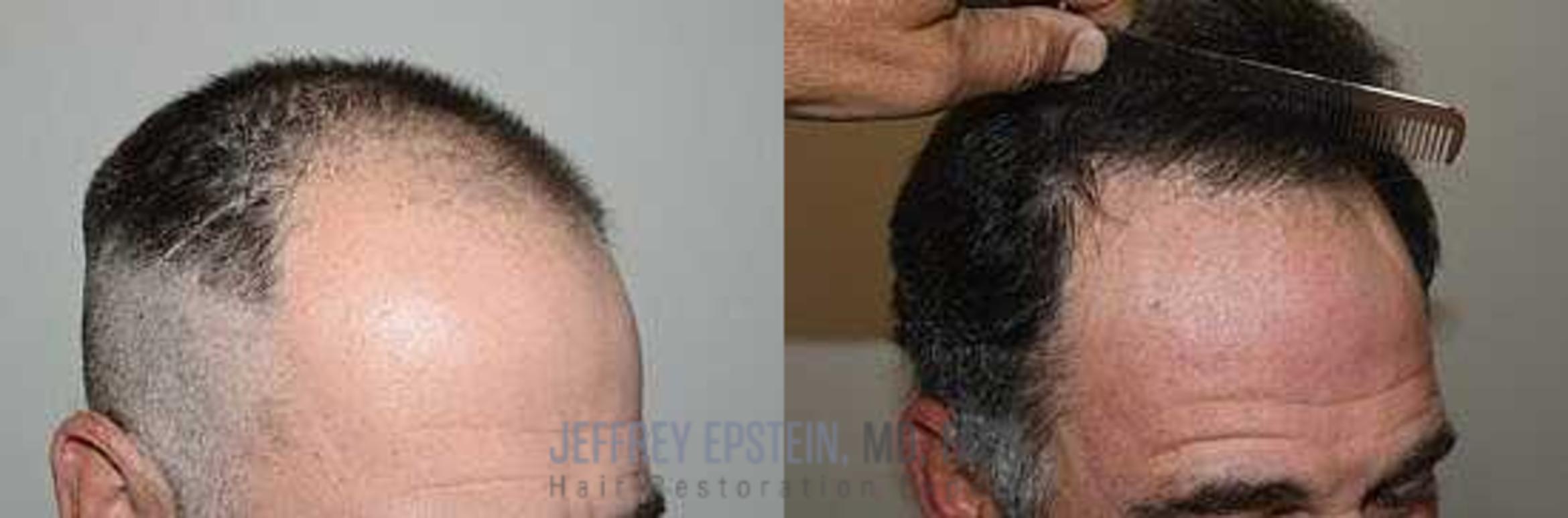 Before & After Hair Transplants For Men Case 15 View 3 View in Miami, FL