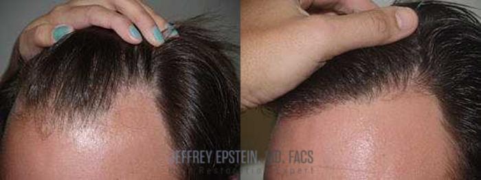 Before & After Hair Transplants For Men Case 151 View 1 View in Miami, FL