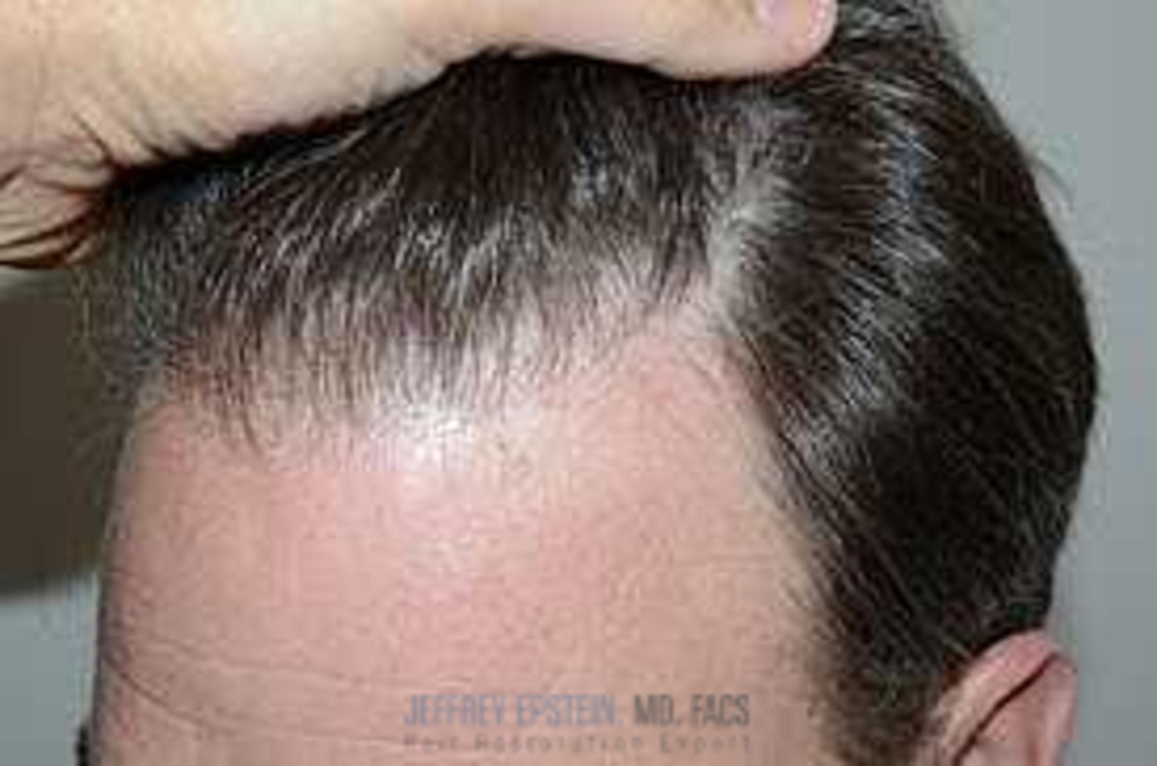 Before & After Hair Transplants For Men Case 151 View 2 View in Miami, FL