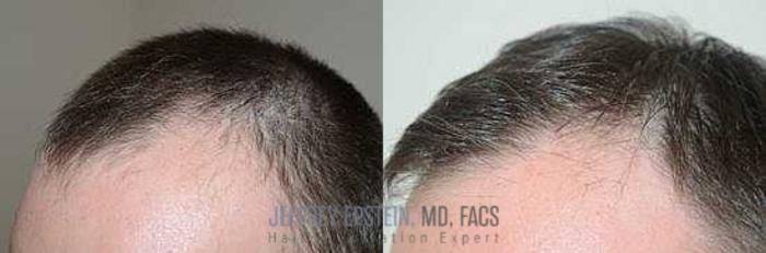 Before & After Hair Transplants For Men Case 152 View 1 View in Miami, FL
