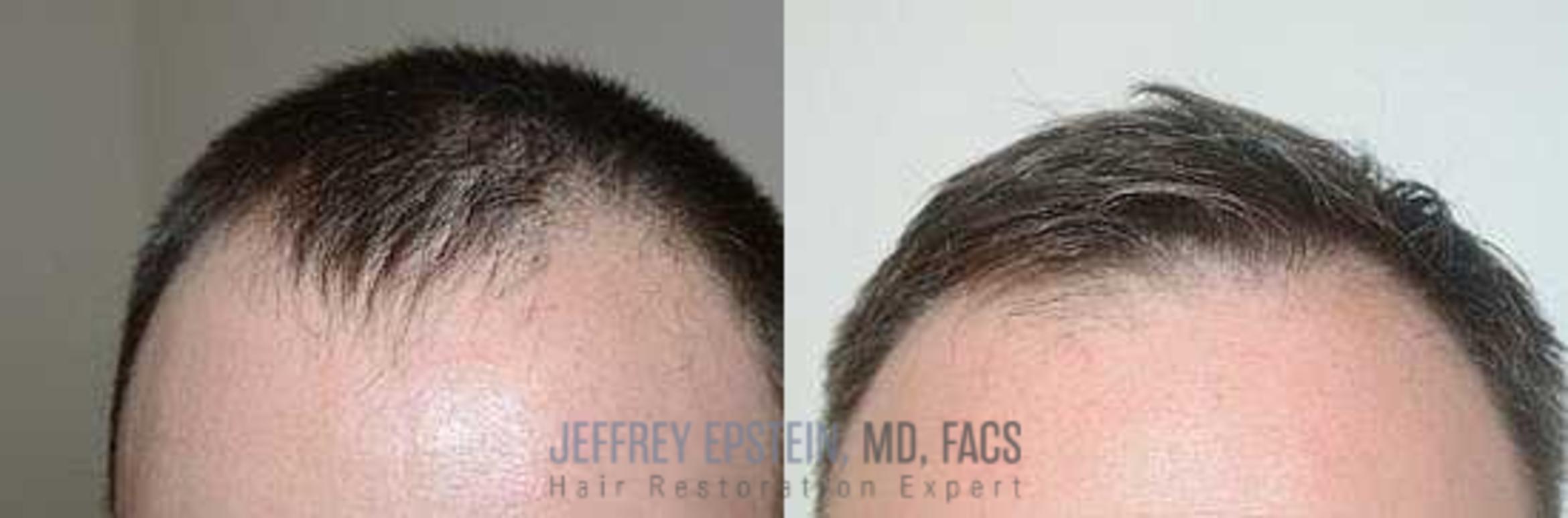 Before & After Hair Transplants For Men Case 152 View 2 View in Miami, FL