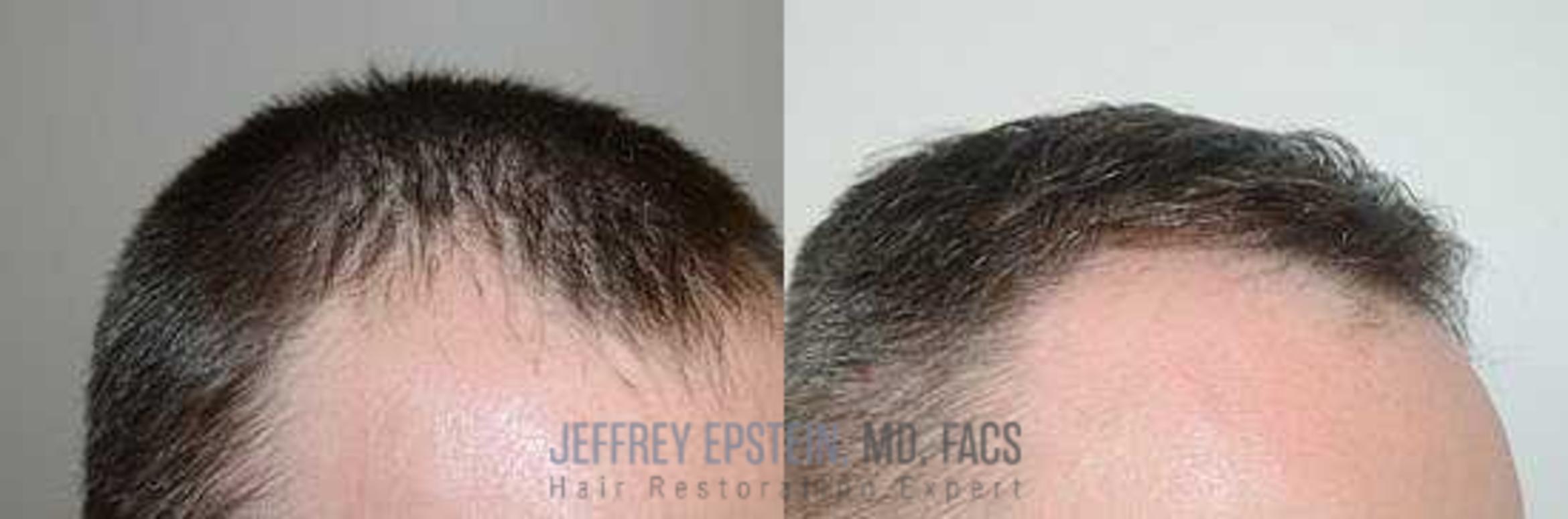 Before & After Hair Transplants For Men Case 152 View 3 View in Miami, FL