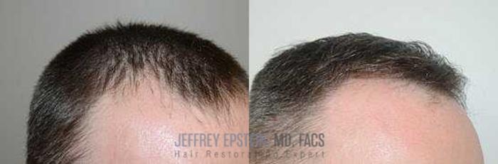 Before & After Hair Transplants For Men Case 152 View 3 View in Miami, FL