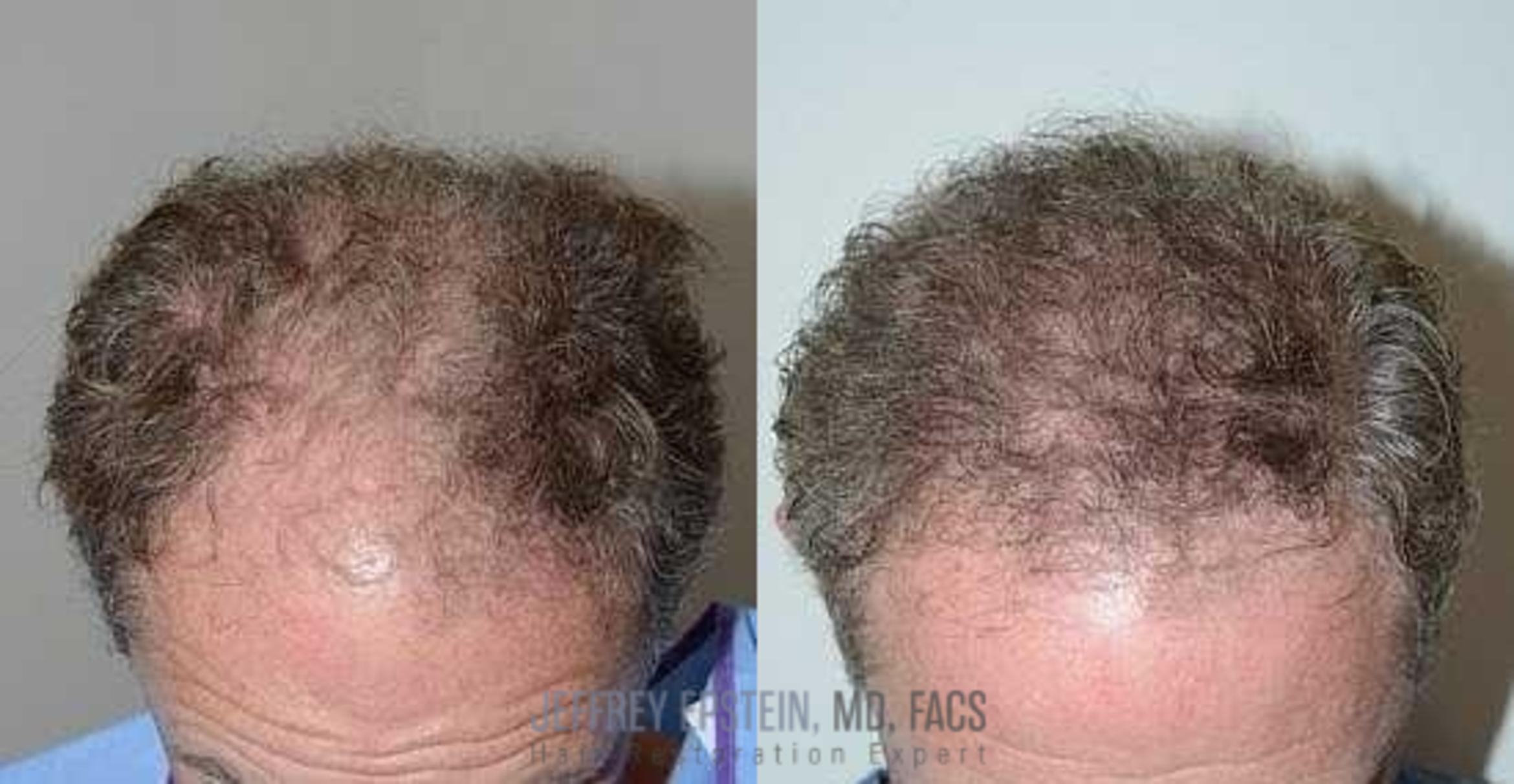 Before & After Hair Transplants For Men Case 153 View 1 View in Miami, FL