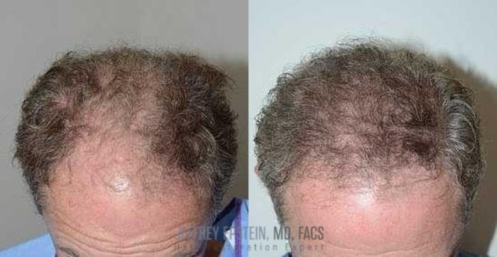 Before & After Hair Transplants For Men Case 153 View 1 View in Miami, FL